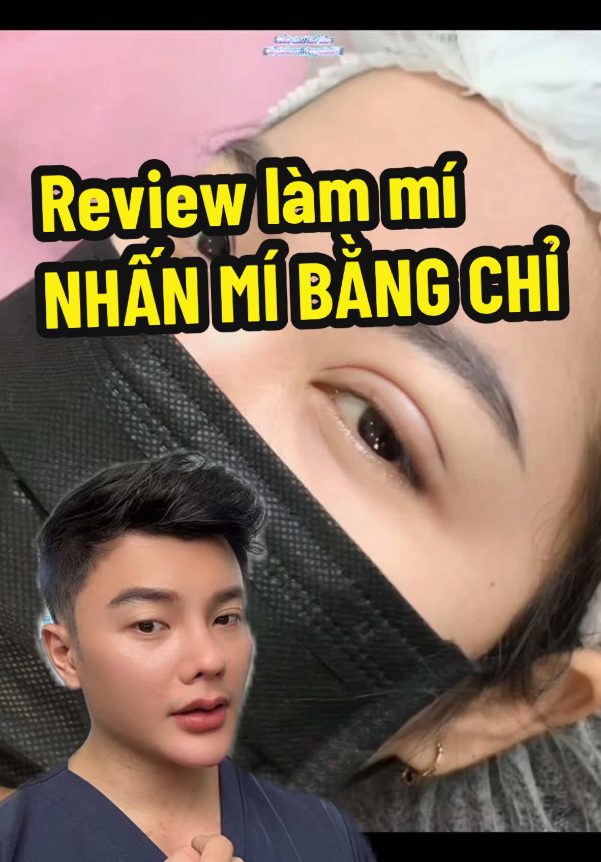 @Ngô Đồng - Chuyên Cắt Môi💋Mí✨ Nhấn mí bằng chỉ sẽ đẹp nhất khi mắt không bị da chùn nhiều và bọng mỡ nhiều nha, còn nếu có cả 2 thì mình làm cắt mí minideep sẽ ok hơn  #ngodongreviewlamdep #reviewlamdep #LearnOnTikTok #nhanmi #nhanmimat #nhanmibangchi #nhanmitunhien 