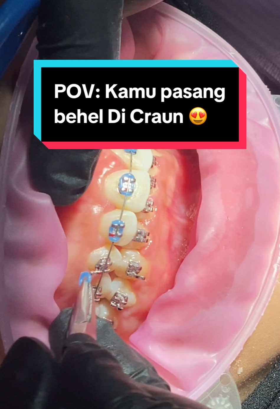 Jadi kapan kamu rapiin gigi di Craun? #klinikgigisurabaya #klinikgigimalangraya #SmileWithCraun #pasangbehelgigi #promobehelgigi #fyp 