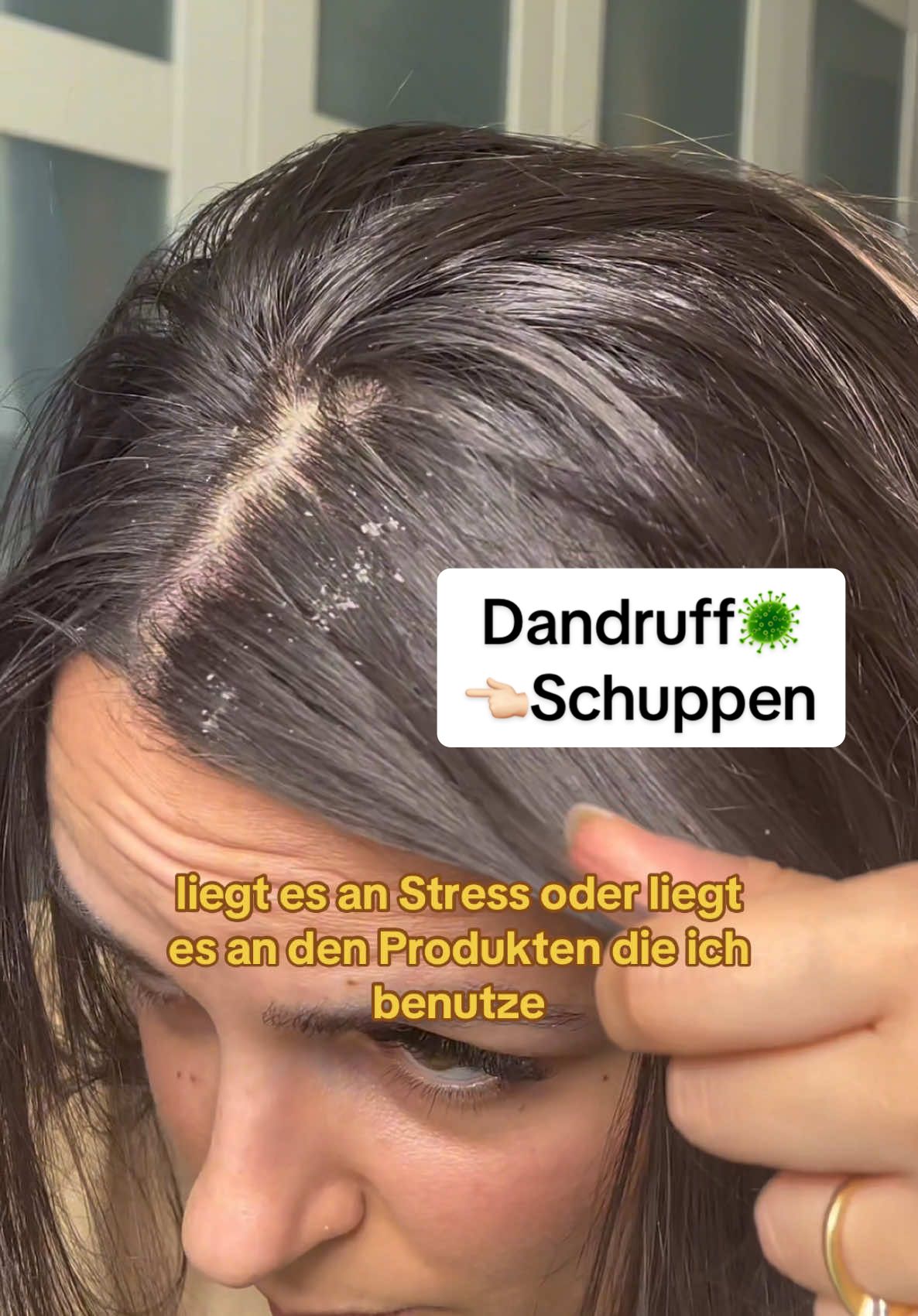 Ich habe es geschafft. Du kannst es auch schaffen. Eine gesunde Kopfhaut ist die Basis von langen gesunden Haaren. Fang endlich an in deine Haarpflege zu investieren👇🏻 🔗Den Link zu meinen Produkten findest du in meiner Biografie❤️ - #schuppen #dandruff #schuppenflechte #dandruffproblem #kopfhautpflege #gesundehaare #haarpflegetipps #haarpflegeprodukte 