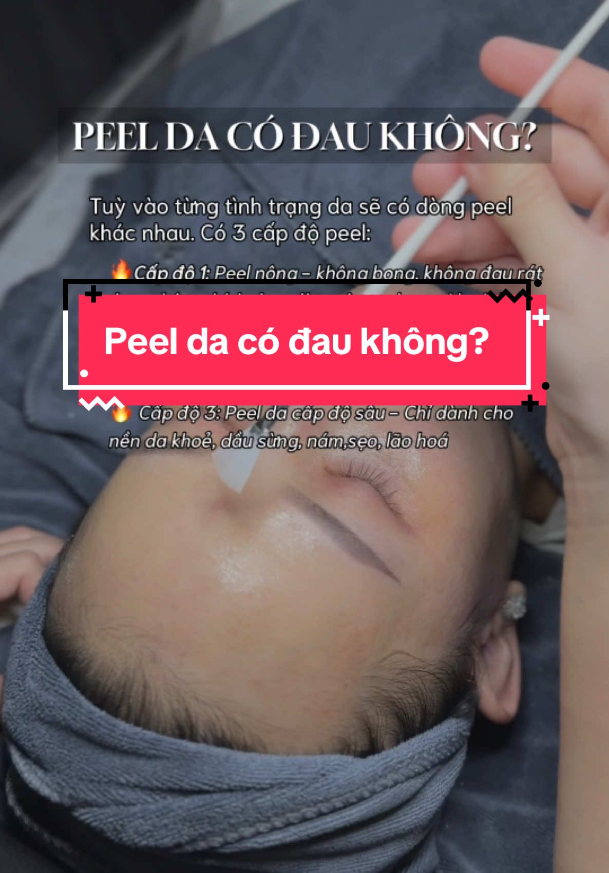 Peel da có đau không? 😳😳 #bovisspa #spauytin #spauytindanang #spadanang #spadanang #spadananguytin #spadanangchuyendieutri #spatrimun #trịmụn #trimun #trimuntritham #trimunchuanykhoa #peel #peelda #duocmypham #skincare #skincareroutine #skincaretips #chamdadontet #trắngda #laynhanmun 