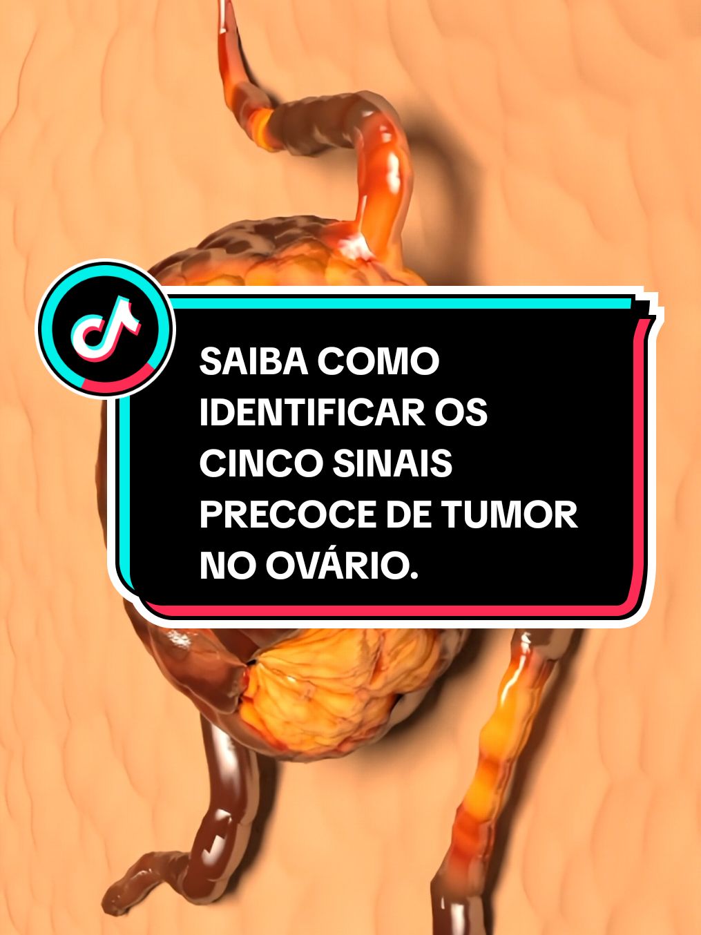 SAIBA COMO IDENTIFICAR OS CINCO SINAIS PRECOCE DE TUMOR NO OVÁRIO..