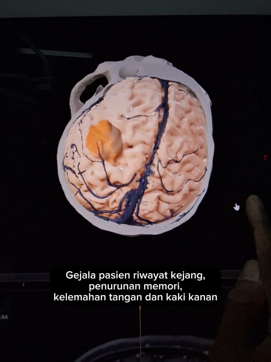 Gambaran MRI tumor otak dengan rekonstruksi 3D #tumorotak #braintumor #braincancer #kangkerotak #medical #health 