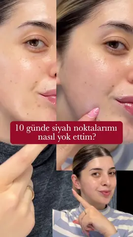 Anua - Niacinamide 10% + TXA 4% Serum cildinizi en güzel versiyonuna ulaştırmak için geliyor. 😍 🌟 Etkili Leke Karşıtı Bakım: 14 gün içinde berrak ve eşit bir cilt tonu sağlar. ✨ Cilt Parlatıcı İçerik Kombosu: Daha aydınlık ve sağlıklı bir görünüm için özel formülasyon. ❌ Koyu Leke ve Hiperpigmentasyonu Önleme: Leke oluşumunu azaltarak cilt tonunu eşitler. 🌿 Geniş Gözenek Karşıtı Bakım: Gözeneklerin görünümünü küçülterek cildin daha pürüzsüz olmasını sağlar. . Video ve görüşleri için @stojkovaa 'a teşekkürler! . Detaylar ››› korendy.com.tr/anua . @anua.skincare #anua #korendy #KoreKozmetik #KoreCiltBakim #KoreGuzellik #KBeauty #CrueltyFree #HayvanDeneysiz #VeganDostu #DogalCiltBakim