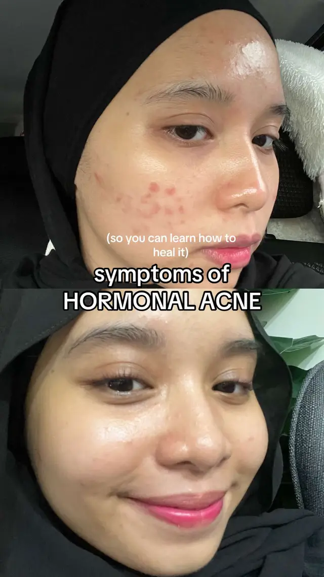 you need to know your acne type before you try to treat it! *click link in bio to know more* #hormonalacne #clearskin #acne #skintok #explore #typ