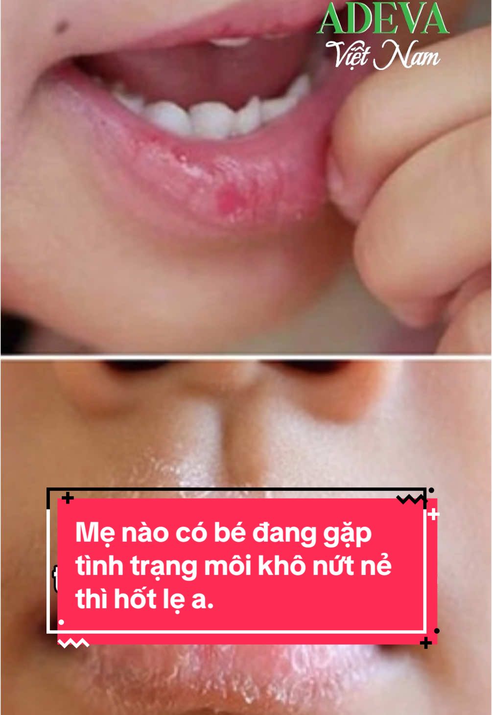 Mẹ nào có bé đang gặp tình trạng môi khô, nứt nẻ thì hốt lẹ a. #adevanoni #sonduong #sonduongthiennhien #sonduongmoi #adevavietnam #sanphamxuhuong #sonduongchobe 