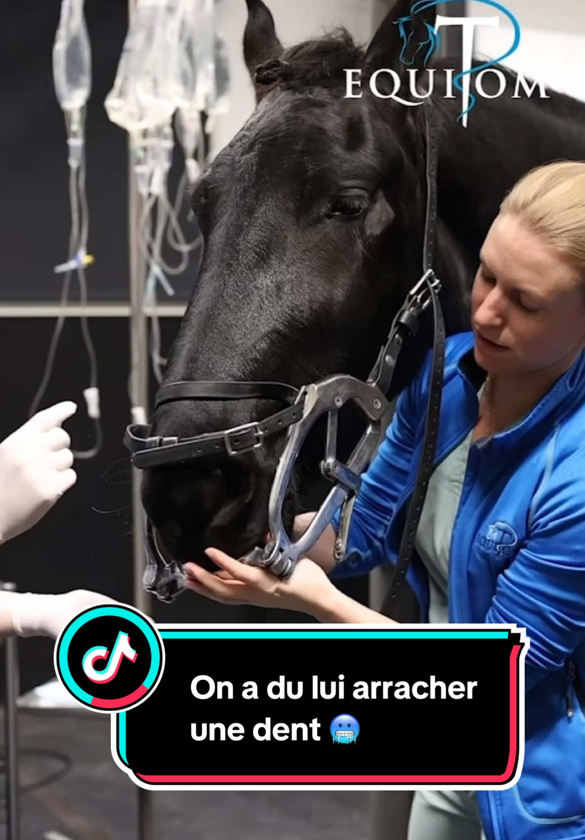 Ce cheval de 5 ans est arrivé chez nous avec un gonflement au niveau de la mâchoire supérieure. Après un examen plus approfondi, nous avons découvert qu'il s'agissait d’une infection de la racine dentaire – un problème malheureusement aussi possible chez les jeunes chevaux.  🔹 Bien que les dents semblaient normales lors du contrôle de routine, une radiographie a confirmé nos soupçons. Ce type d'infection est souvent causé par l'anachorèse, où des bactéries présentes dans la circulation sanguine infectent la dent. La solution ?  ✔️ La dent a dû être retirée pour éliminer l'infection et la douleur. Heureusement, cette intervention se fait désormais rapidement et en toute sécurité sous sédation et anesthésie locale.  👉 Après l'intervention, il est important de surveiller le cheval. Les chevaux s’adaptent bien à la perte d'une dent, mais des contrôles réguliers (tous les six mois) sont essentiels pour suivre l'évolution et corriger les dents si nécessaire. 😊Nous sommes heureux que ce cheval soit maintenant sans douleur et de retour à sa vie normale  #pferd #cheval #cavalo 