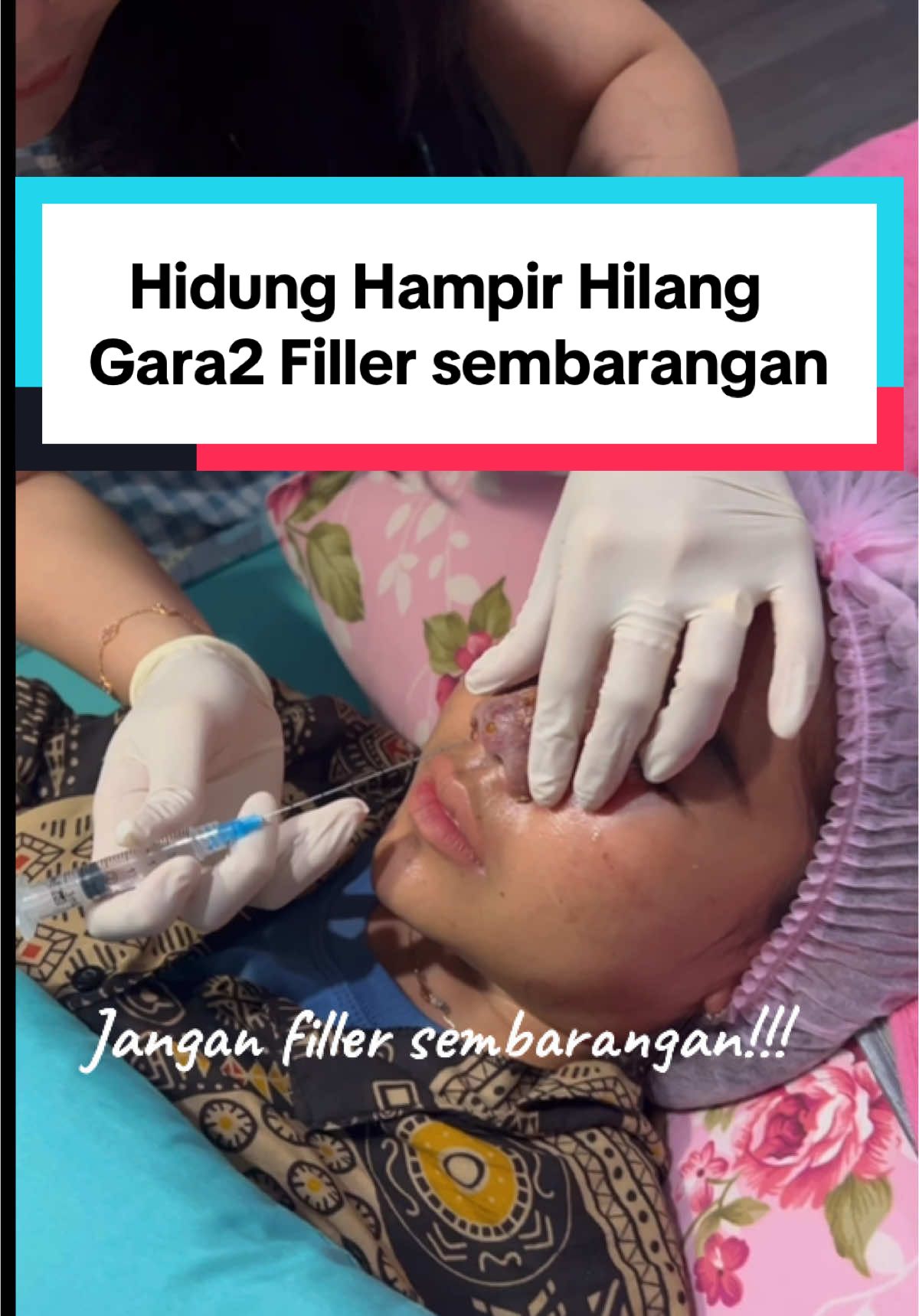 hati2 filler hidung sembarangan!!! #nekrosis #fillerhidung #fillerhidunggagal #komplikasi #komplikasifiller #dokterabalabal #nekrosishidung #filler #fillergagal #abalabal #estetik #dokterdina #dermaglam #bukandoktercinta #drdinaoktaviani 