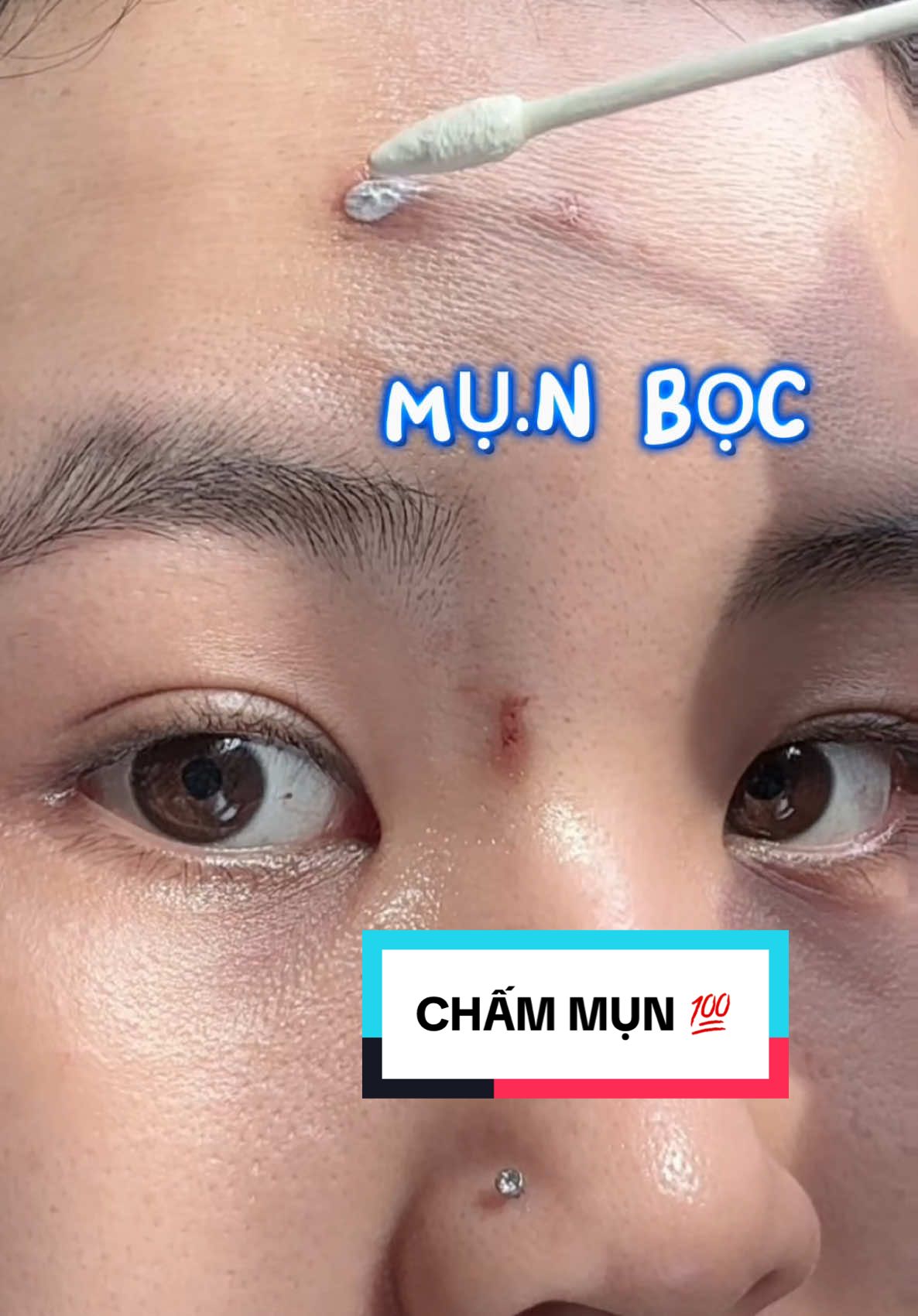 M.ụn chỗ nào chấm chỗ đó ✅ #Drleo #Drleovn #chammun #chammundrleo #skincare #fyp #skincareroutine #xuhuong #trending #tipslamdep #chamsocda 