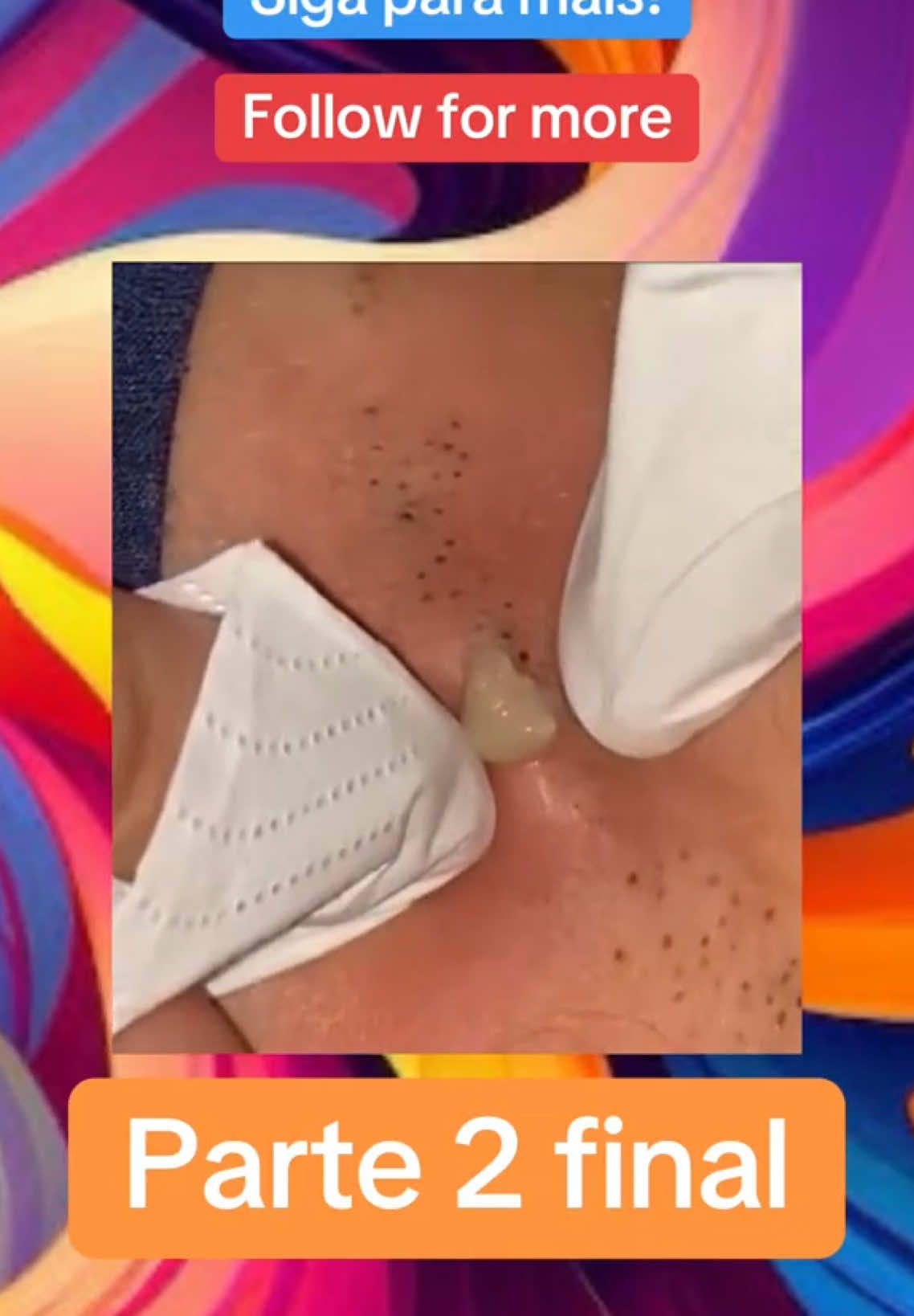 Parte 2 de 2 , para ver as outras partes clique na playlist abaixo deste vídeo. Gostaria de ver este vídeo sem filtro ? Se inscreve na comunidade !  Clica na estrela amarela logo acima da descrição desse vídeo  👆🏻 #blackheads #pimples #pimplepopper #acne #squeeze #squeezeuk #pimplepoppersatisfying #limpezasatisfatoria #reagindo #cravos #removal #Fyu #fyp #satisfyingvideo #cyst #cystremoval #cistosebaceo #blackhead #ニキビ #クローブ #皮脂嚢胞 #嚢胞 #顔のニキビ #ニキビを取り除く #満足のいく #creatorsearchinsights 