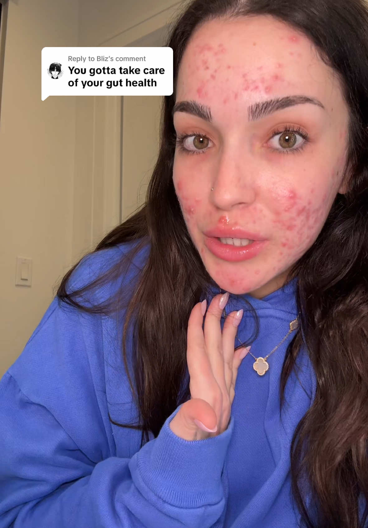 Replying to @Bliz Yes some of these comments may be to help me and let me know that it may be from my gut health, but I have seen A LOT of people assume that this is the ONLY reason why people have acne. This can be a part of the reason, but it is not the only. I also get that the dairy I eat may not seem healthy to some, but I see it as healthy! Don’t get me wrong I also eat a little chocolate here and there but I don’t eat unhealthy everyday! Hope this makes sense!🤍 #fyp #foryoupage #acne #acnejourney #acnetips #skin #skintok #relatable #accutane #guthealth #controversy 