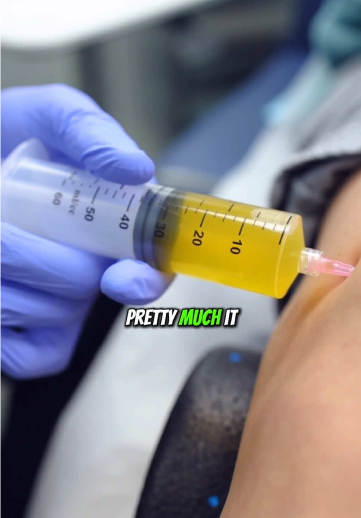 How to alleviate knee pain? Knee aspiration is a quick procedure where excess fluid is drained from the knee joint using a needle. It helps reduce swelling, alleviate pain, and improve mobility. This simple procedure can provide relief and speed up recovery, getting you back to your routine in no time! #kneepain #painmanagement #painrelief 