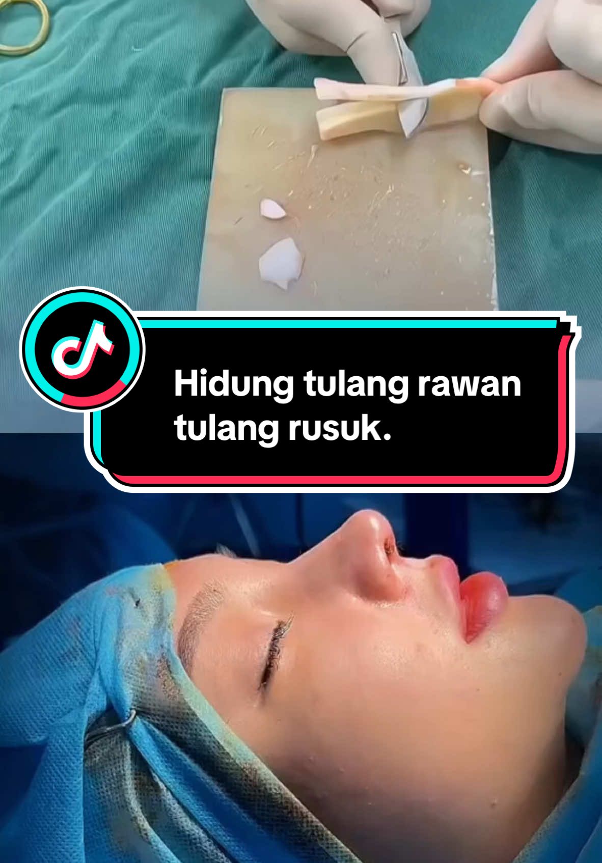 Hidung tulang rawan tulang rusuk... #operasi,#rhinoplastistruktur #hidung,#nose,#douyin #indonesia,#nangmuitrunghoa #angkathidung,#rhinopsty,#eyelidsurgery