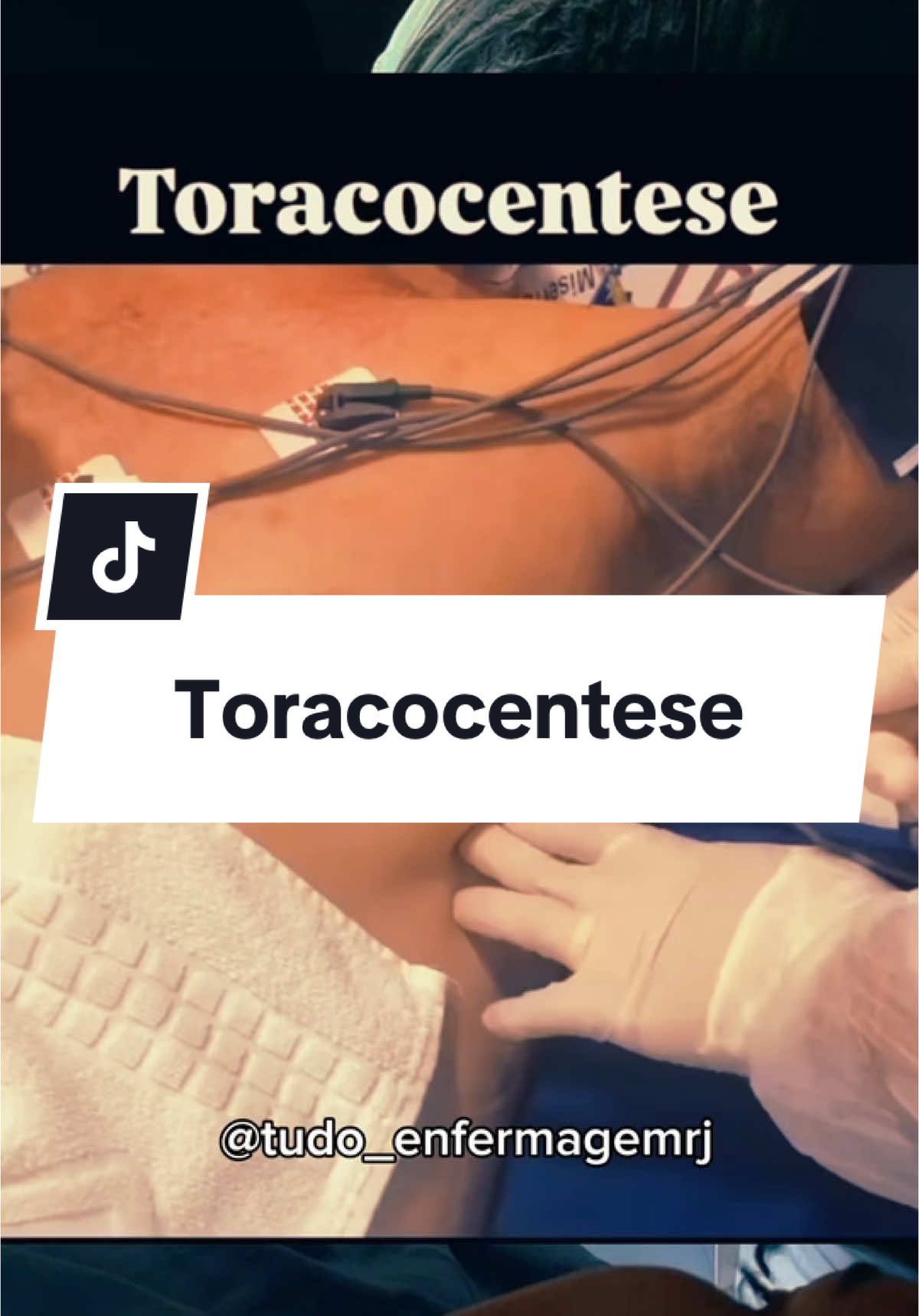 A toracocentese, também conhecida como punção pleural, é um procedimento médico que consiste na introdução de uma agulha na cavidade torácica para remover líquido ou coletar uma amostra. Pode ser realizada com fins diagnósticos ou terapêuticos.  A toracocentese é indicada para: Remover um derrame pleural, ou seja, um acúmulo anormal de líquido no espaço pleural  Aliviar sintomas como dor no peito e falta de ar  Obter amostras de tecido para biópsia da pleura #enfermagem #hospital #tecnicoemenfermagem #nurse #enfermeiratiktok #viral #urgencia #medicina #emergency 