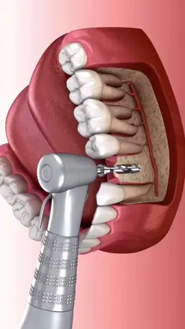 İmplant Uygulama . . #animation #dental #dentalcare #implant #dentist #fyp #hollywoodsmile #zirkonyum #smiledentist #pro #taximdentalist #yapayzeka #fyp #viralvideos #keşfetteyiz #artificialintelligence #taksim #taksimmeydan #istanbul #turkey🇹🇷 
