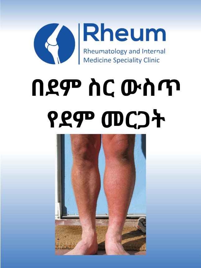 Deep venous thrombosis ሩሁም የሩማቶሎጂ እና የውስጥ ደዌ ስፔሻሊቲ ክሊኒክ #rheum #deep #veins #thrombosis #DVT 