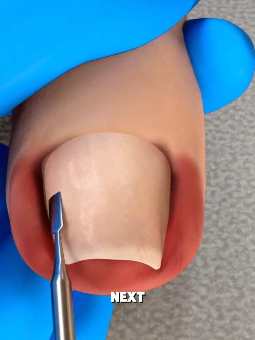 INGROWN TOENAIL TREATMENT SURGERY 3D ANIMATION  #ingrowntoenail #ingrowntoenailremoval #ingrowntoenailtreatment #ingrowntoenailremovalanimation #toe #toenail #toenailremoval #toenailsurgery #toenailfungus #medical3danimation #3dmedicalanimation 