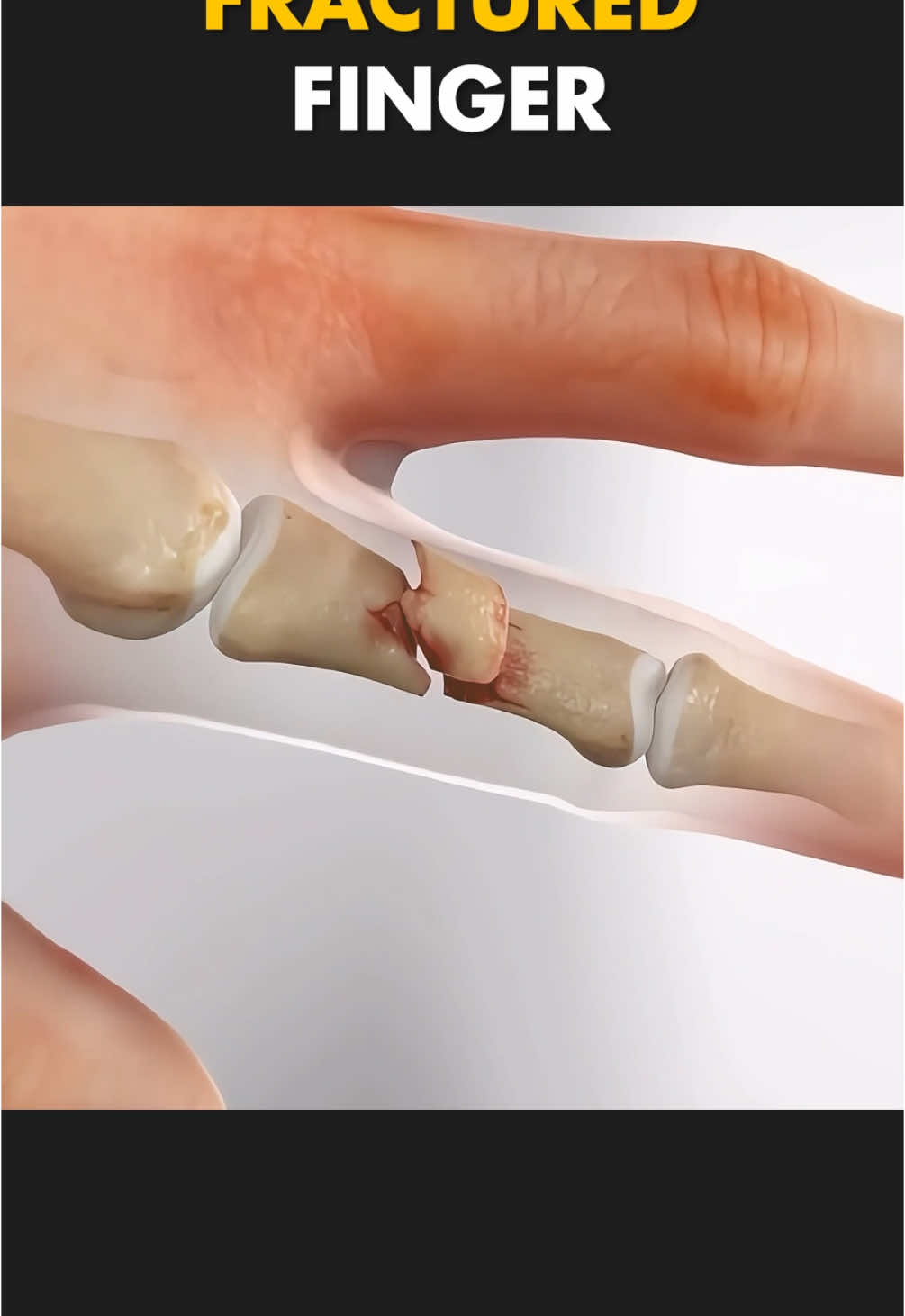 How Fractured Finger Is Treated? (3D Animation) #bonefracture #bonefracturerepair #fracture #fingerfracture #fingerfractureinjury #fingerinjuries #fingerinjuryrecovery #intramedullary #medical3danimation #3dmedicalanimation #bonefracturehealing #handfracture 