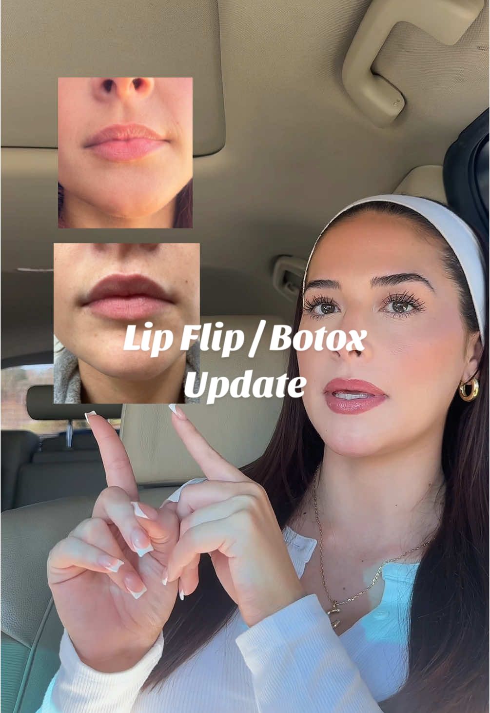 Replying to @Robyn Collins my results of my botox & lip flip! So happy with my results! #botox #botoxcheck #lipflipresults #lipflip #lipflipcheck #lipflipbeforeandafter 