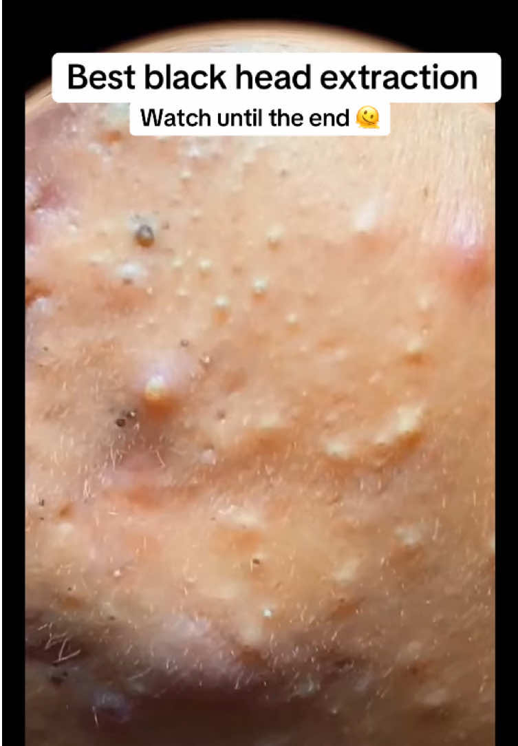 #BlackheadExtraction #BlackheadRemoval #Blackheads #PimplePopper #AcneTreatment #SkinCareRoutine #ClearSkin #AcneSolutions #SkinCareAddict #BlackheadExtractor #PoreCleaning #DeepCleansing #ExtractionTools #SkinExtraction #FacialExtraction #SkincareTools #PoreUnclogging #SkinCareTips #SkinCareLover #FaceCare #HealthySkin #GlowingSkin #CleanSkin #SkinHealth #FaceCleaning #OddlySatisfying #SatisfyingVideo #SatisfyingSkincare #RelaxingSkincare #SkinCareASMR #BlackheadSatisfying #DrPimplePopper #BlackheadVideos #SkincareTikTok #BlackheadChallenge #ViralSkincare #AcneRemoval