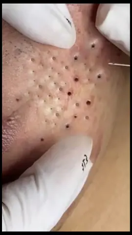 #BlackheadExtraction #BlackheadRemoval #Blackheads #PimplePopper #AcneTreatment #SkinCareRoutine #ClearSkin #AcneSolutions #SkinCareAddict #BlackheadExtractor #PoreCleaning #DeepCleansing #ExtractionTools #SkinExtraction #FacialExtraction #SkincareTools #PoreUnclogging #SkinCareTips #SkinCareLover #FaceCare #HealthySkin #GlowingSkin #CleanSkin #SkinHealth #FaceCleaning #OddlySatisfying #SatisfyingVideo #SatisfyingSkincare #RelaxingSkincare #SkinCareASMR #BlackheadSatisfying #DrPimplePopper #BlackheadVideos #SkincareTikTok #BlackheadChallenge #ViralSkincare #AcneRemoval