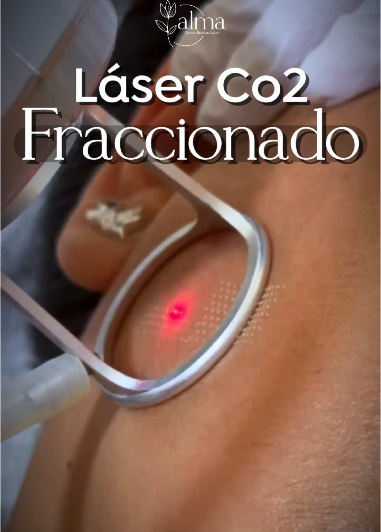 ✨ Renueva tu piel con láser CO2 fraccionado en ALMA Centro Estético Láser ✨ ✔️ Eliminar cicatrices de acné ✔️ Reducir arrugas y líneas de expresión ✔️ Estimular la producción de colágeno para una piel más firme y joven 📲 Agenda tu evaluación personalizada y comienza tu cambio hoy mismo. #laserco2fraccionado #tecnologialaser #secuelasdeacne 