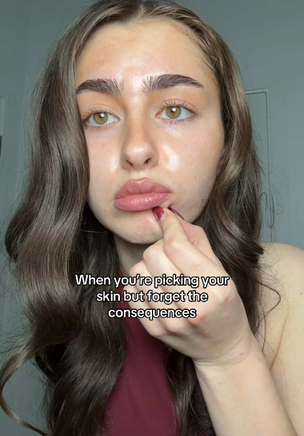 Is that HYPERPIGMENTATION  #skinpicking #acne #acnescars #discoloration #hyperpigmentation 