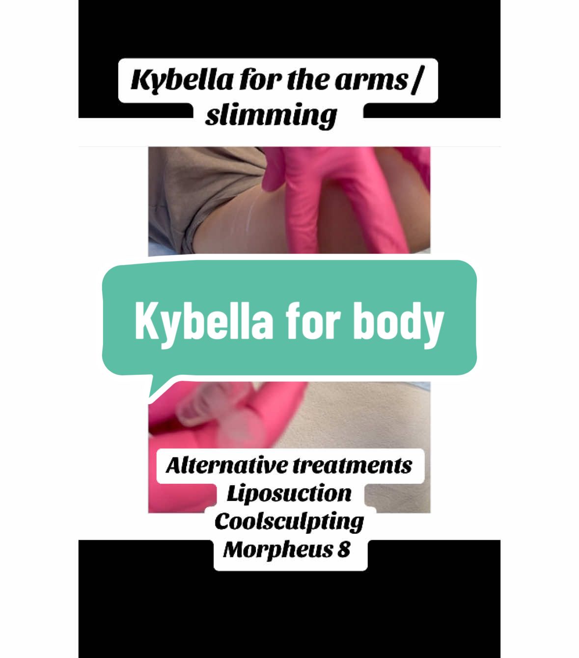 Stubborn body fat? Kybella isn’t just for chins! 💉 Target small pockets of fat on the body for a smoother, more sculpted look. Safe, effective, and no downtime. Book your consultation today! #KybellaBody #TargetedFatLoss #BodyContouring #NonSurgical #AestheticGoals #ConfidenceBoost #SculptedLook #BodyGoals #sanfrancisco #nonsurgical #nonsurgicalfatreduction #slimarms #tonedarms 