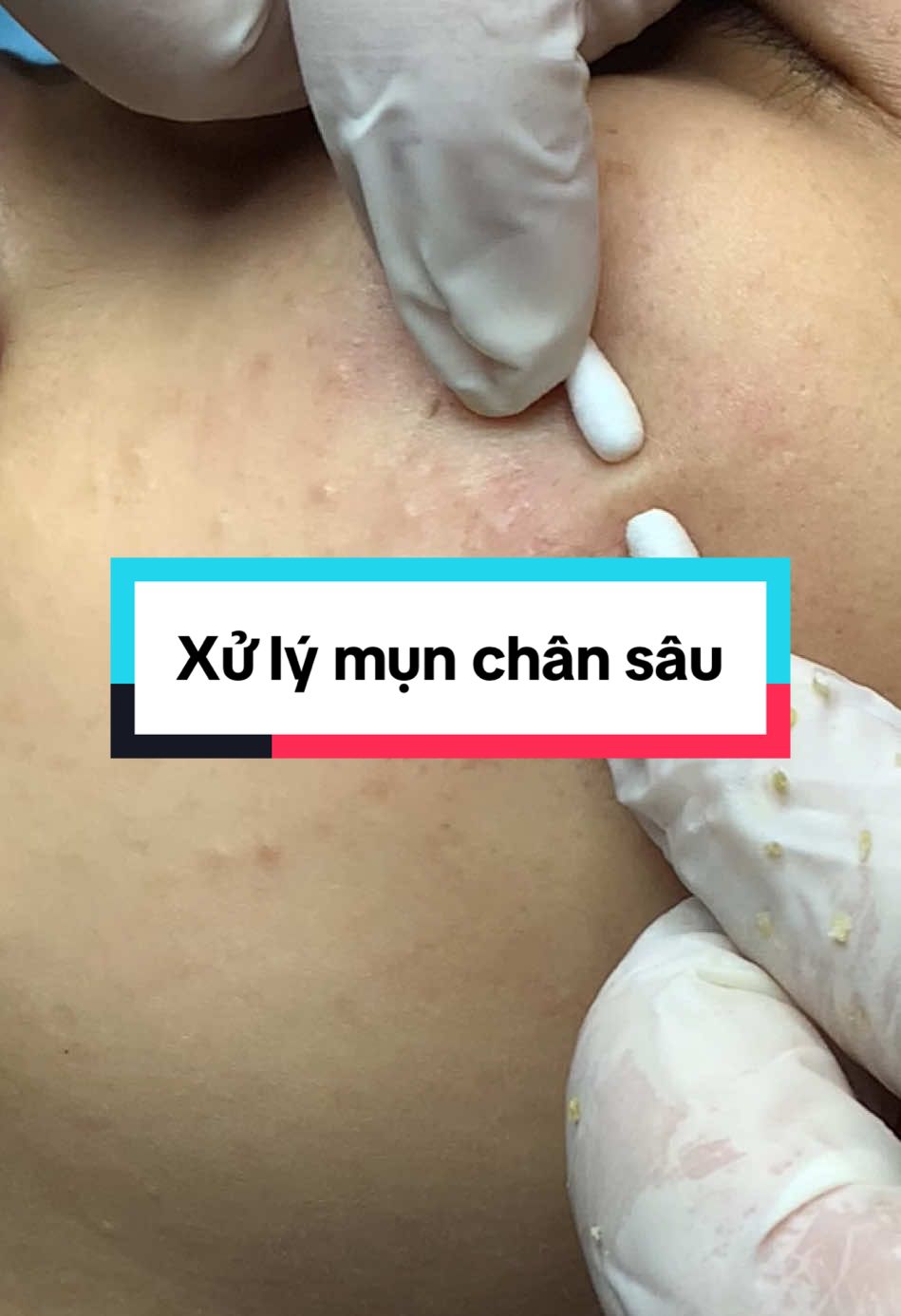 Chân mụn cực kỳ sâu #laymuntambong #cleohousephunhuan #bìnhdương #Cleohousebinhduong #ghienmun #nặn_mụn 