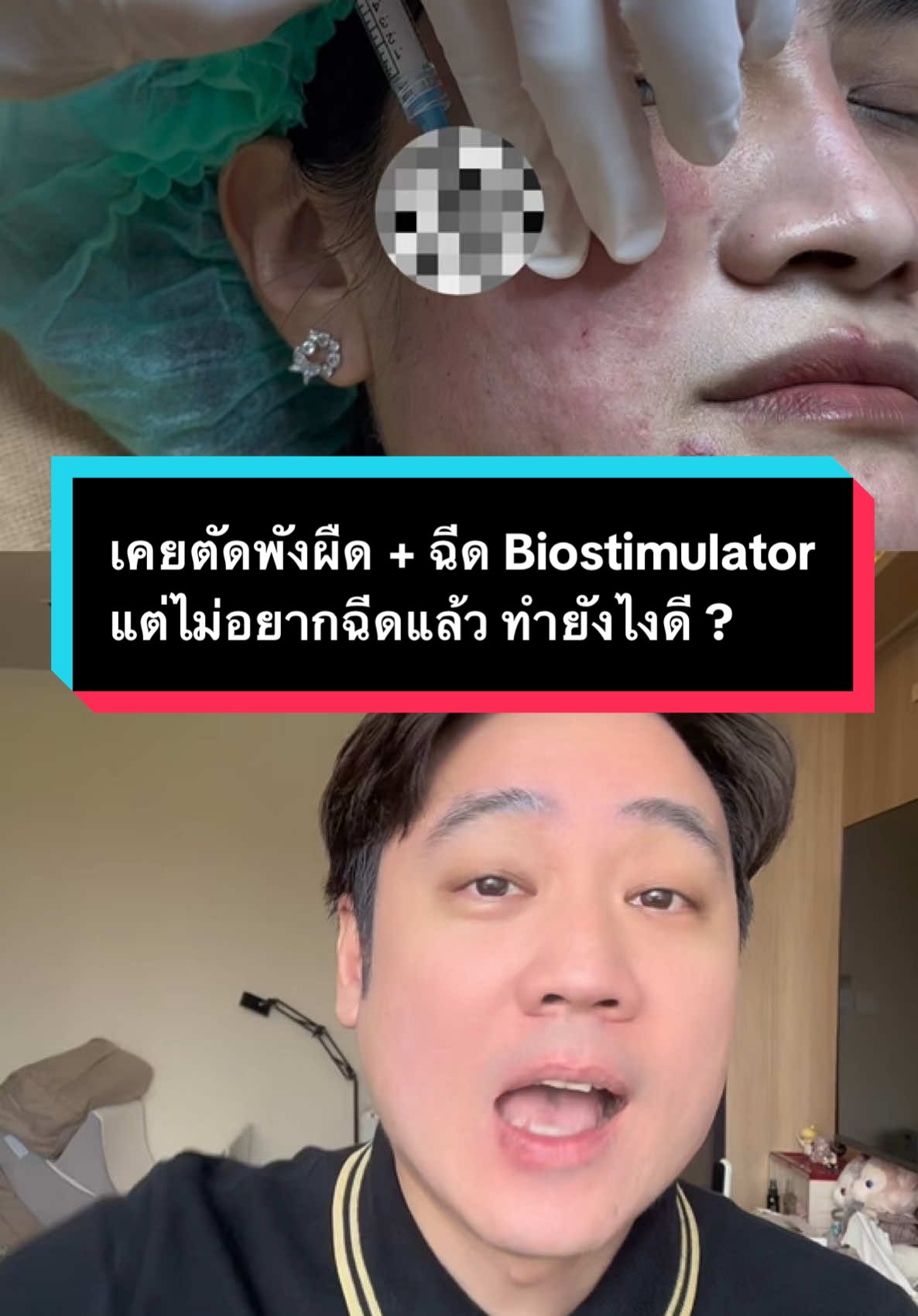 เคยตัดพังผืด + ฉีด Biostimulator แต่ไม่อยากฉีดแล้ว ทำยังไงดี? #หลุมสิว #ตัดพังผืดหลุมสิว #subcision #biostimulator #มิราเบลหลุมสิว #รักษาหลุมสิว2025 