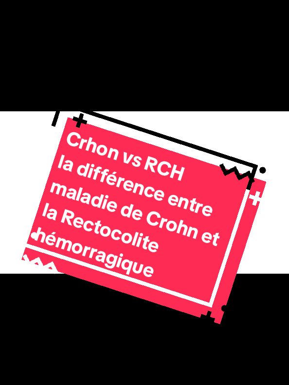 La maladie de crhon est l'une des maladies inflammatoires chroniques de l'intestin (MICI) avec la réctocolite hémorragique. Elle est liée à une hyperactivité du système immunitaire digestif. ◽ L'inflammation se traduit par une muqueuse intestinale fragile, inflammatoire<<irritée>>, siège d'ulcérations plus ou moins profondes qui peuvent aller jusqu'à la perforation pouvant provoquer des abcès au contact de l'intestin malade. ◽ Elle peut évoluer  souvent vers des phases d'activité appelées