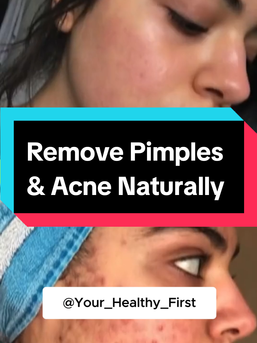 You can make all your pimples disappear with only two ingredients. #pimple #acne #skincare #skincaretips #skincareroutine  This magical treatment fights acne breakouts and skin irritations. #naturalremedy #naturalrecipes #remedy #recipes #Recipe 