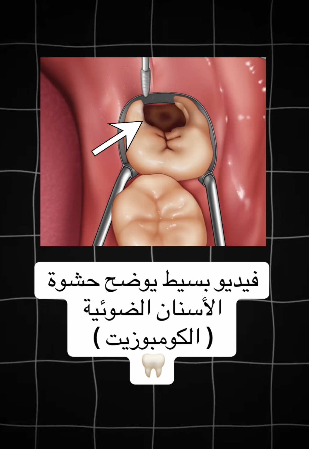 #طب_اسنان #طب_الاسنان #حشوة_الاسنان #حشوات_تجميليه #حشوات_الاسنان 