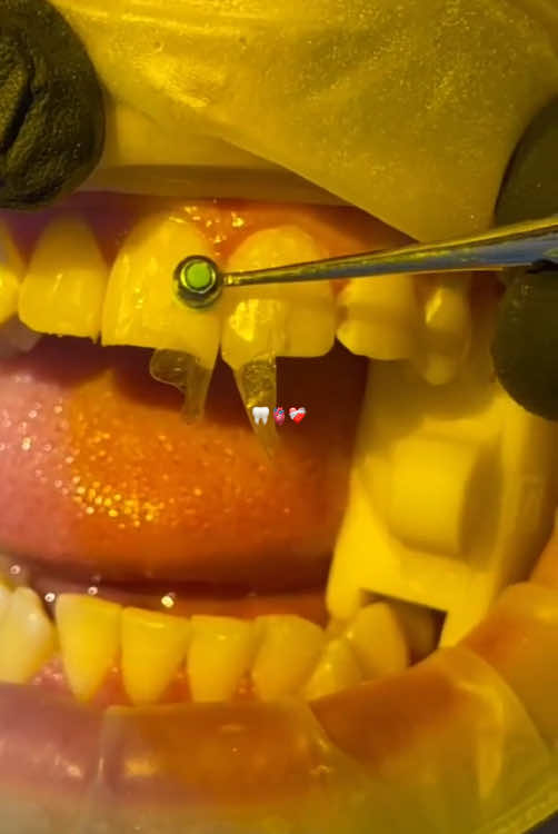 Part 246 |#creatorsearchinsights #creatorsearchinsights🫀🦷❤️‍🩹 #foryou #f #foryoupage❤️❤️ #foryoupageofficiall #fo #for #goviral #fpy #fby #tiktokviral #teeth #a #p #toot #laserfilling #brushingteeth #crownbridgefixteeth #t #d #dentalimplants #dentalworld🦷🦷#tranding #tik_tok #trendingvideo #tik #viral#teethwhitening #dentist 🪥🎭🦷🫀❤️‍🩹😷