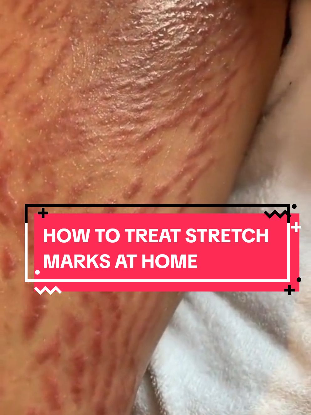 How to treat stretch marks naturally with vaseline, coconut oil and Alovera gel. stretch marks remedy #skincare #stretchmarksremedy #stretchmarks #naturalRemedies #naturalrecipes