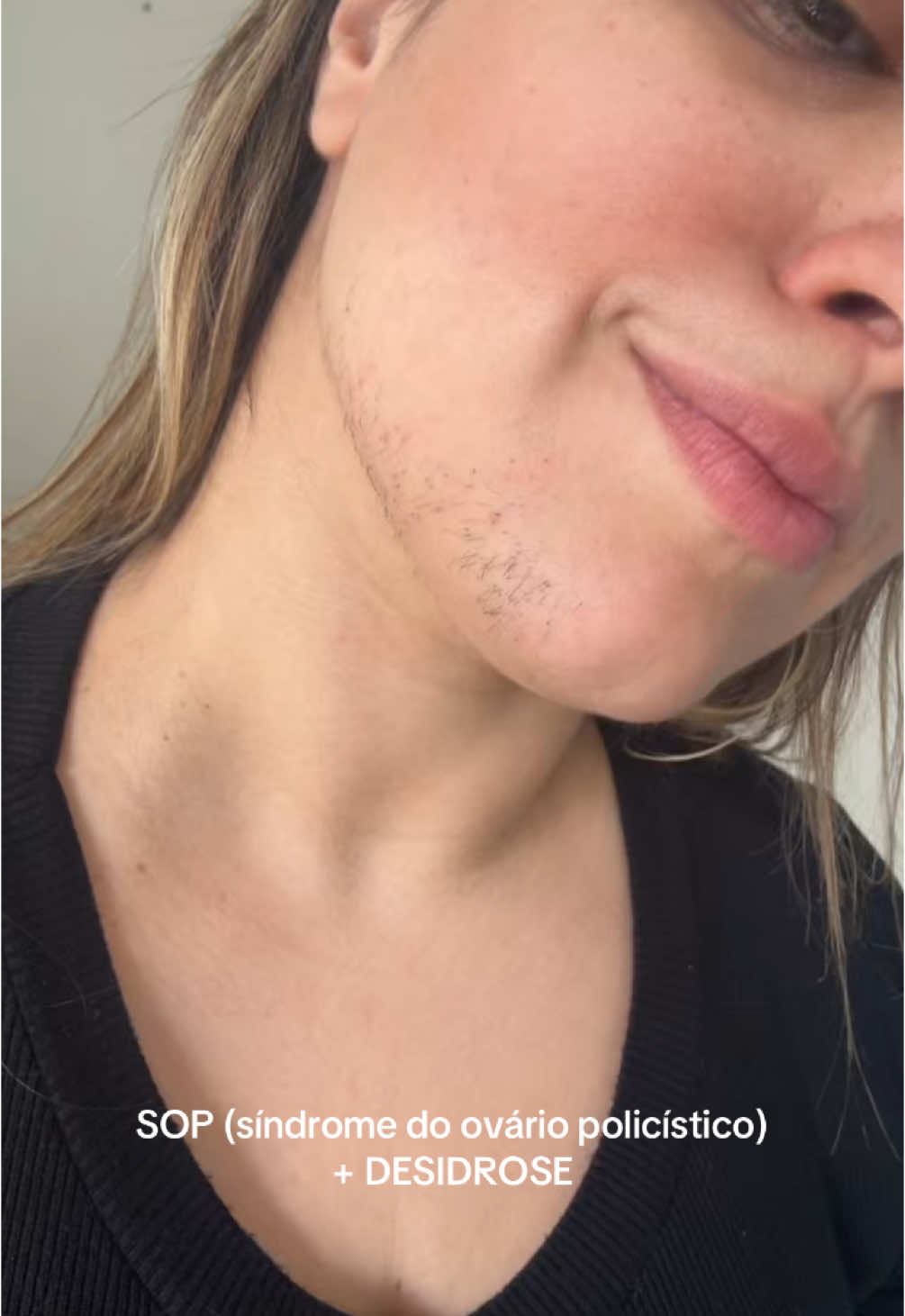 ‼️ANTES DE JULGAR, LEIA A LEGENDA!👇🏻  😢 Eu tenho pavor desses  #pelosnorosto que me deixam com aspecto de mulher barbada.  Não é “relaxo”.  1 vez por semana faço o rosto na linha, dura um pouco mais. Já tentei cera, laser… mas não adianta.  Essa é uma das características da #SOP, a síndrome dos ovários policísticos que atinge cerca de 6 a 12% das mulheres em fase reprodutiva.  É uma luta diária com a #balança e #hormônios.  Não existe cura, mas existe #tratamento com mudança no estilo de vida. E comecei minha jornada.  A #Desidrose fere.  Mesmo não sabendo a causa certa essas bolinhas de água coçam demais. Fica feio, mas passa.  Insegurança. Tantos medos que, se eu for listar falta espaço.  Mas uma coisa eu sei: tenho coragem pra viver.  E desejo que você também tenha. Cuide-se. É você por você, sempre e pra sempre!  E se precisar de ajuda, vamos juntas! ✨💕 #fyp #autocuidado #autoestima #365semfalhar #sop #sindromedeovariopoliquistico #resistenciaainsulina ##hormonios##hormonal#mulheres #fertilidade #gravidez 