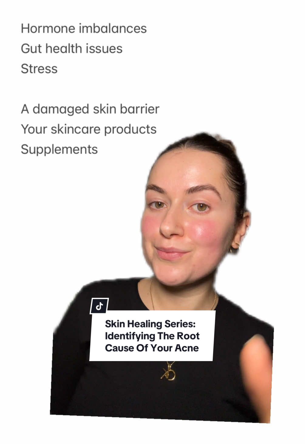 Skin healing series episode 1: understanding the root cause of your acne, this is so important and the first step to take if you want to heal your skin long term! #skintok #skintips #acnetips #skincarejourney #skinhealing #acnejourney #acnefighter #acneproneskin #skintransformation 