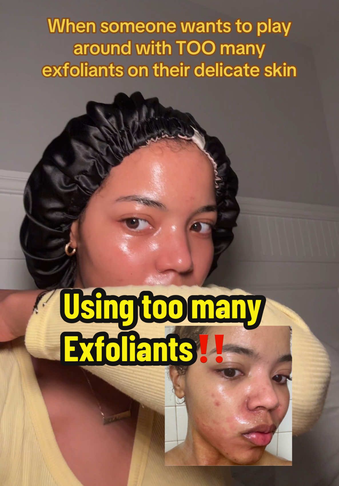 Don’t over do it with the exfoliants, trust me on this one! One in your routine is enough or cycle out exfoliants in your routine. Using too many exfoliants at one point destroyed my skin barrier. Follow for more skincare advice 🫶🏽 #acne #pimples #breakouts #hyperpigmentation #chemicalburn #squidgame 