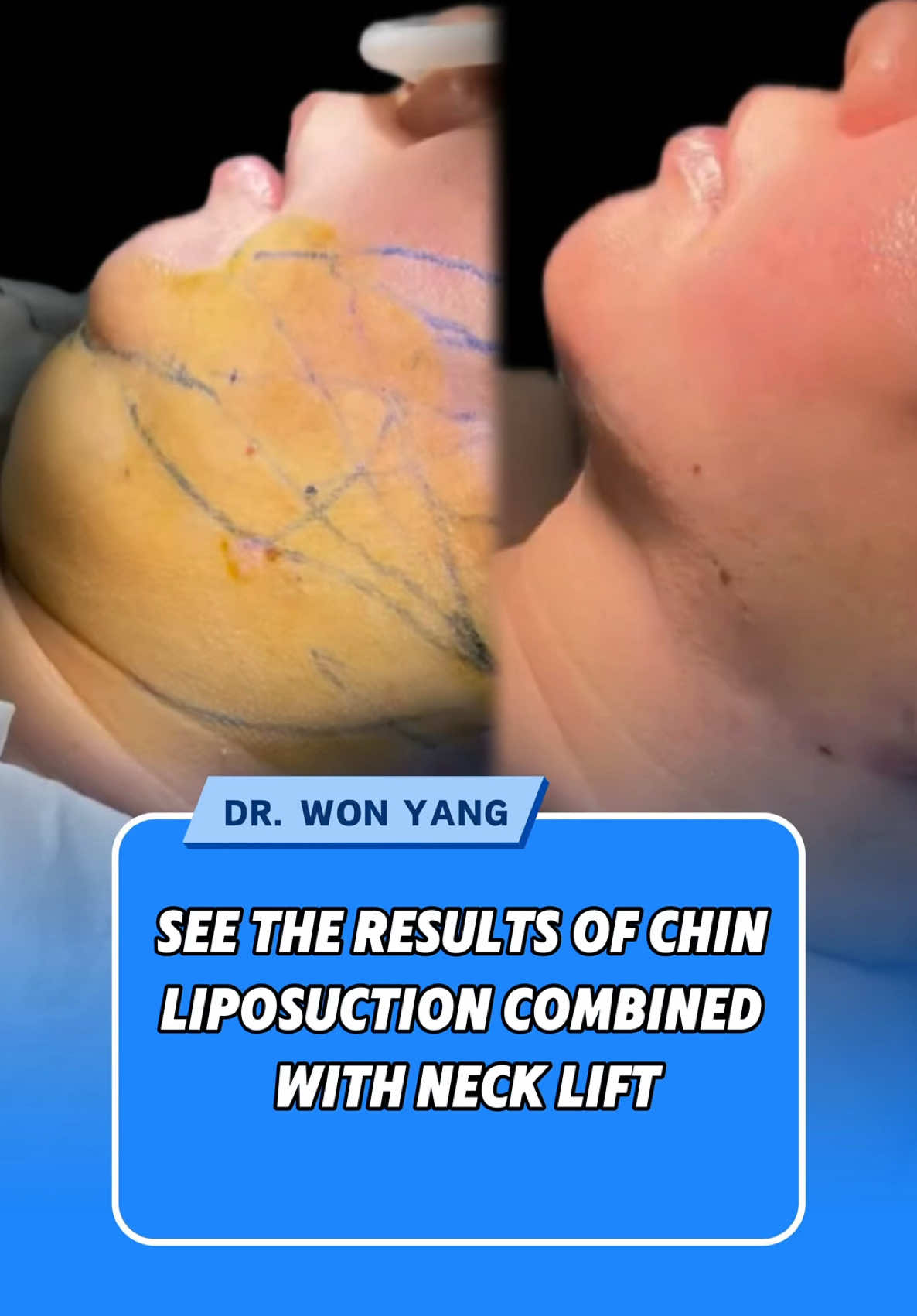 See the results of chin liposuction combined with neck lift #comesticsurgery #chinlipsuction #necklift #necklifting #fyp #kualalumpur #kualalumpurmalaysia #tiktokmalaysia #malaysia #drwonyang 