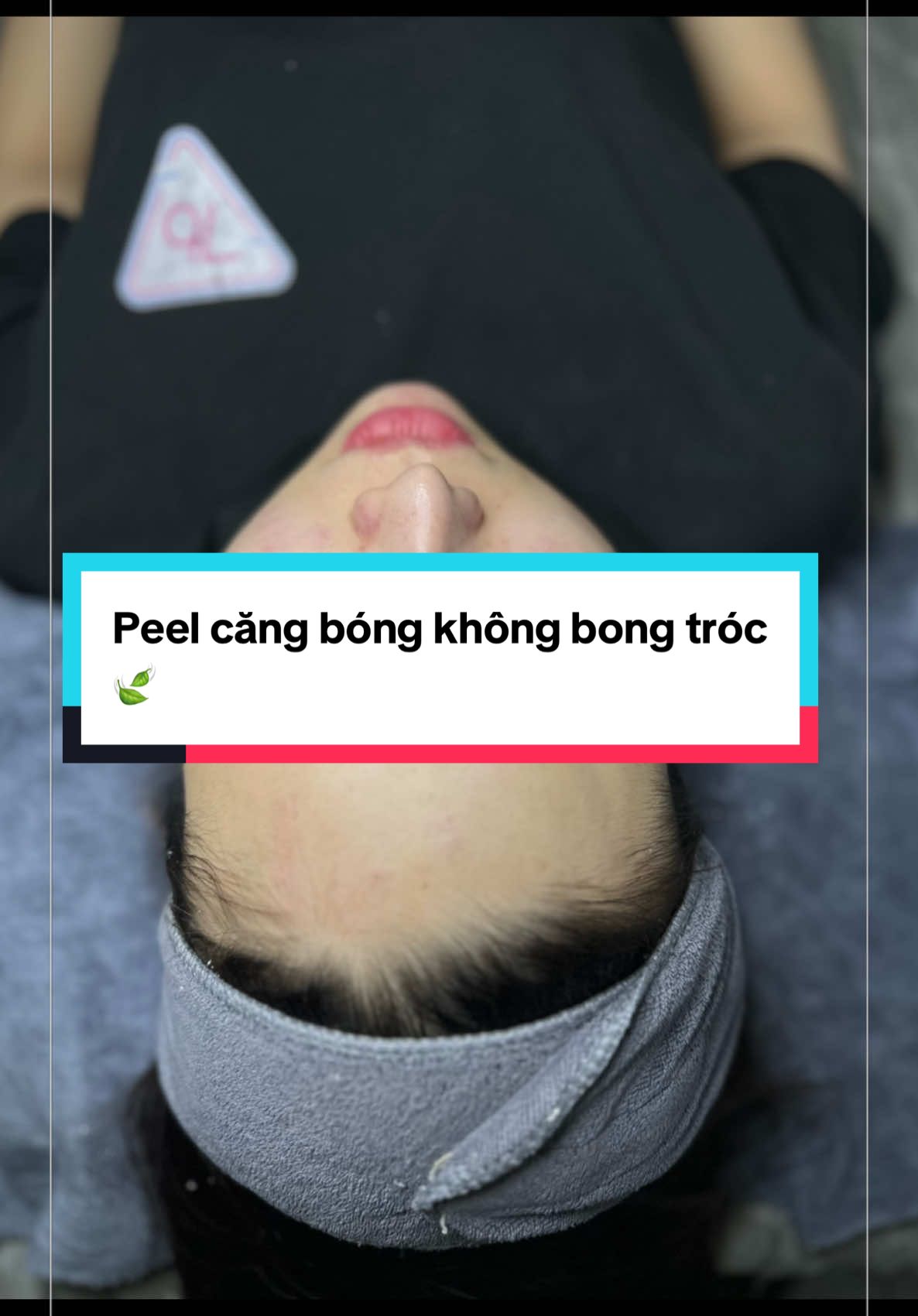 Khách nào peel sợ bong da thì cứ về với đội em nhạ. Vẫn đảm bảo da căng bóng, hấp thụ dưỡng chất, an toàn..  😳😳 #lynmedical #peelda #chemicalpeel #dieutriphacdo #skincare 