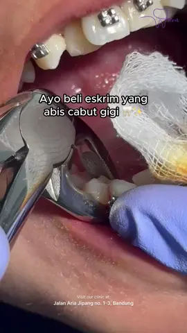 YAP! Setelah cabut gigi, ada baiknya kamu konsumsi makanan dingin seperti es krim untuk bantu meredakan nyeri dan mempercepat proses penyembuhan. Tapi ingat, pilih yang teksturnya lembut ya! Punya pertanyaan seputar perawatan gigi? Tulis di kolom komentar atau DM kami! 💌 #CabutGigi #TipsGigiSehat #DentalCare #RenaDental #KlinikgigiBandung #BrighterSmileWithRena #TipsKesehatanGigi