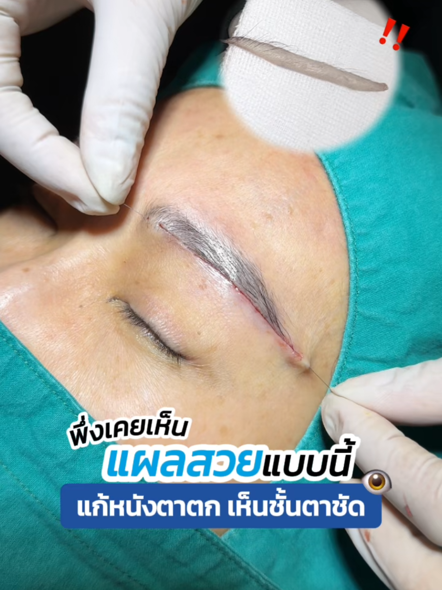 แก้หางตาตก #ซ่อนแผลใต้คิ้ว #subbrowlift #skyclinic #สกายคลินิก #หมอสกาย #ซ่อนไหมไร้รอยเข็ม #ทําตาที่ไหนดี #จักษุแพทย์ #ศัลยกรรมตา #คลินิกทําสองชั้น #ยกคิ้ว #รีวิวบิวตี้ #ผู้สูงอายุ 