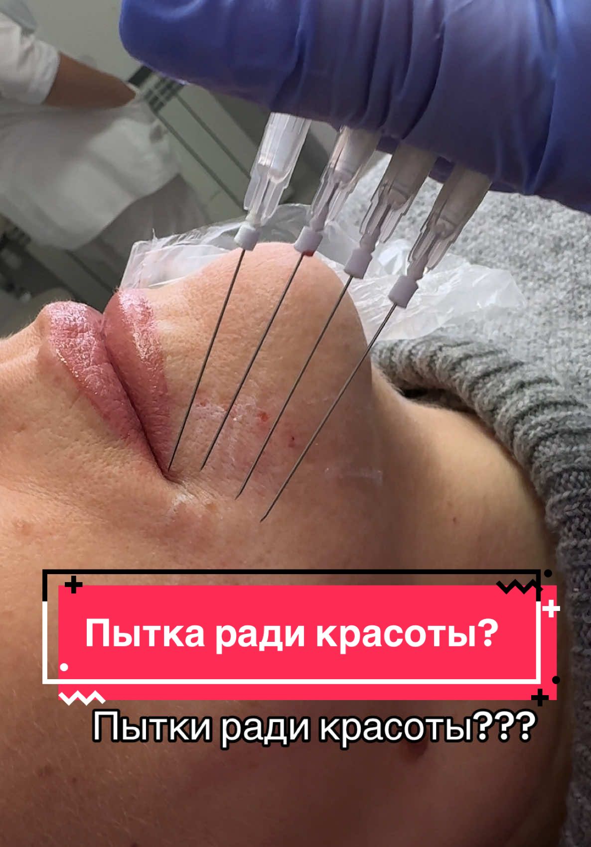 На первый взгляд кажется пыткой??? 😱😱😱 На самом деле все происходит намного легче, чем может показаться   Предваритеоьно наносится крем-анестетик на 15 мин и чувствуется сам прокол, а введение иглы под кожей ощущается минимально  Зато создается прекрасный каркас из коллагена #beauty #косметолог #косметика #рек #рекомендации 