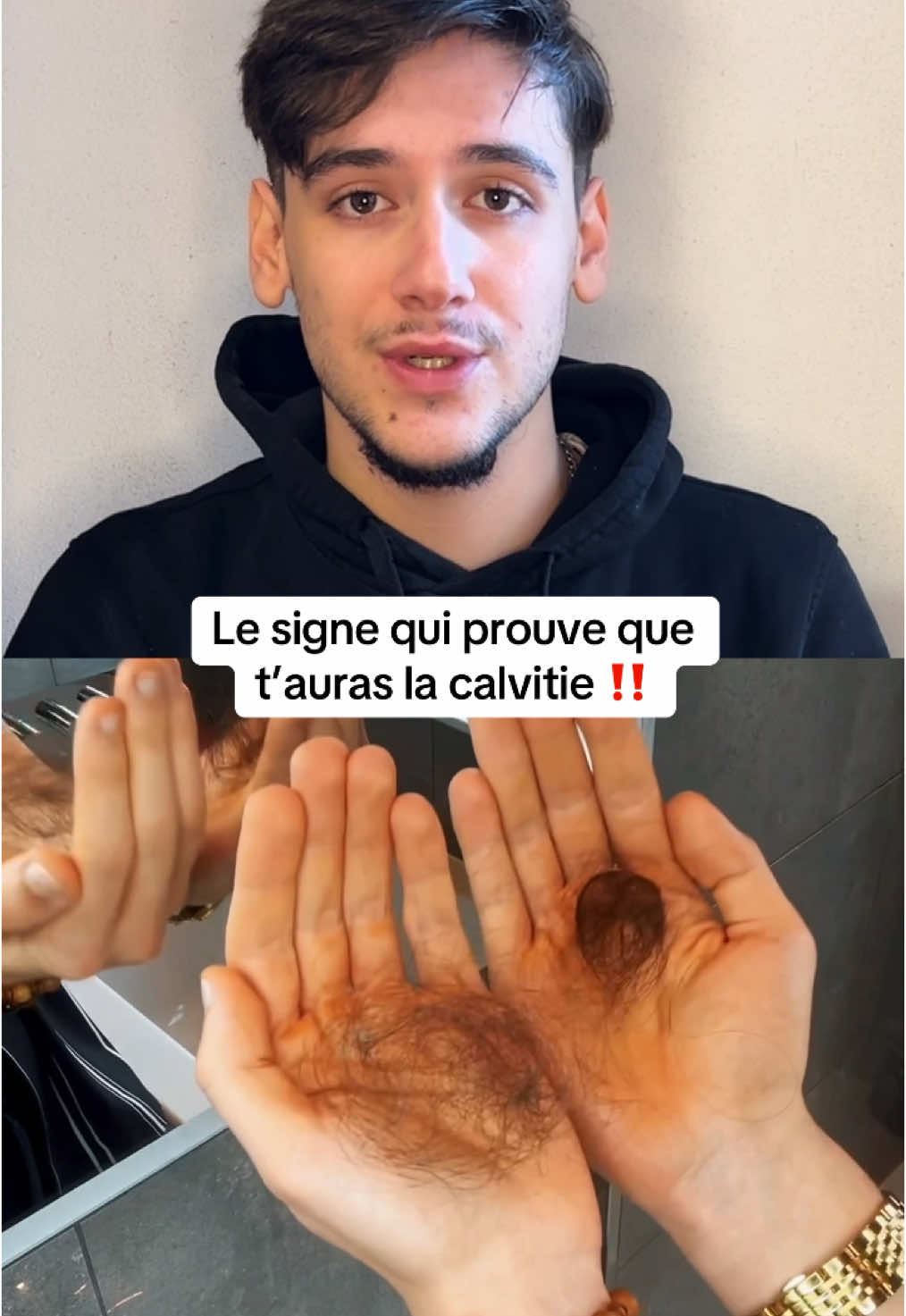 Le signe qui prouve que t’auras la calvitie ‼️ #tips #cheveux #conseil 