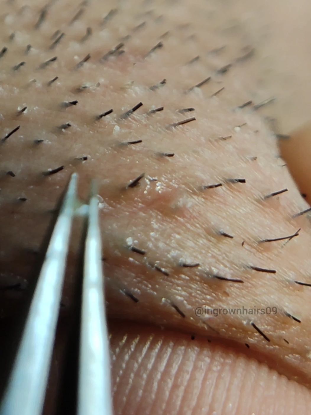 super satisfying extractions! #extractions #ingrownhair #plucking #hairpulling #satisfyingvideo #ingrownhairremoval #tweezers #asmr #relax