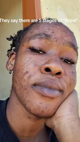Super excited to announce that today Marks exactly 6 months of my oratane treatment, and I can finally say that I'm acne free.🥹❤️ been the worst journey but we made it to the other side.🫦#oratanejourney #isotretinion 
