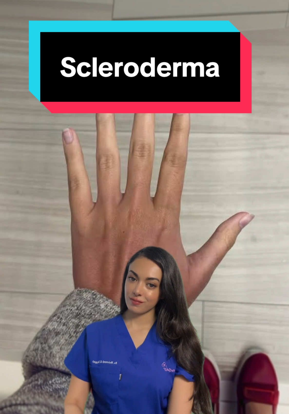 Scleroderma is an autoimmune disease causing skin hardening, tightening, and discoloration. Skin signs include Raynaud’s phenomenon, shiny or thickened patches, ulcers, pigment changes, and calcium deposits (calcinosis). #scleroderma #autoimmune #raynauds #ulcer #skincare #calcinosis #skinproblems #dermatology #foru #foryoupage #fyp 