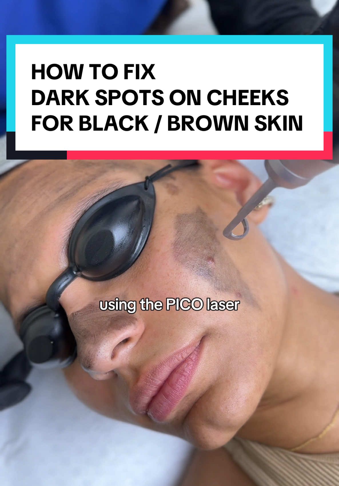 Watch how we FIXED my clients hyperpigmentation on her upper cheeks! INSANE RESULTS 😍 The Pico laser effectively fades acne scars in brown skin by delivering ultra-short bursts of energy to break down scar tissue and stimulate collagen production without damaging surrounding skin. Its precision minimizes the risk of hyperpigmentation, making it safe and effective for darker skin tones. Over a few sessions, it smooths skin texture and reduces the appearance of scars. #skin #black #blackskin #brownskin #face #hyperpigmentation #hyperpigmentationtreatment #darkspots #acne #london #darkskin 