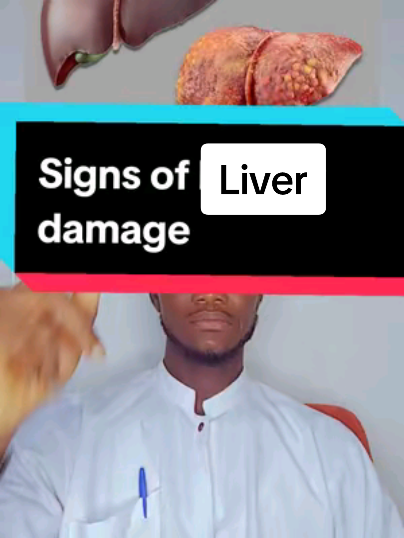 Signs of liver damage and failure. #liver #liverdamage #liverfailure #fattyliver #ketosis #healthyliving #diet #insulin #cirrhosis #hepatitis #liverhealth #liverfailureawareness #medicaleducation #healthcaretips #healthylifestyle 