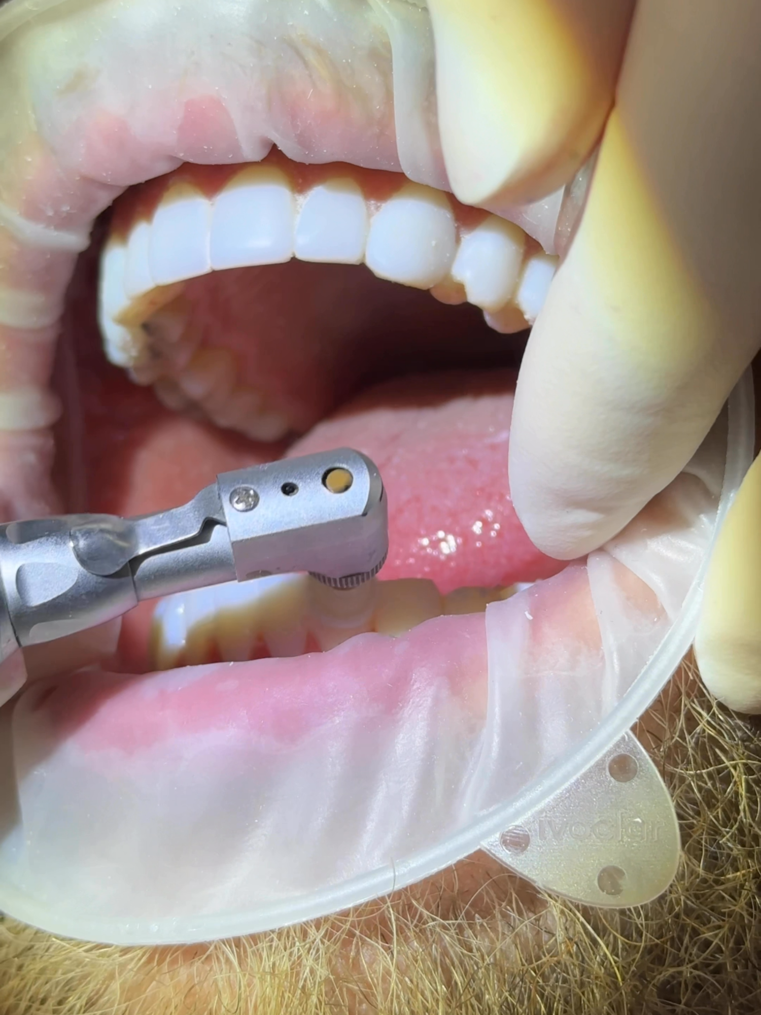 New Year, New Smile! Start 2025 with a healthy, confident grin. Visit us for brighter teeth and healthier gums your smile deserves it!  #veeners #viral #5starsmiles #badbunny #dtmf #janaury