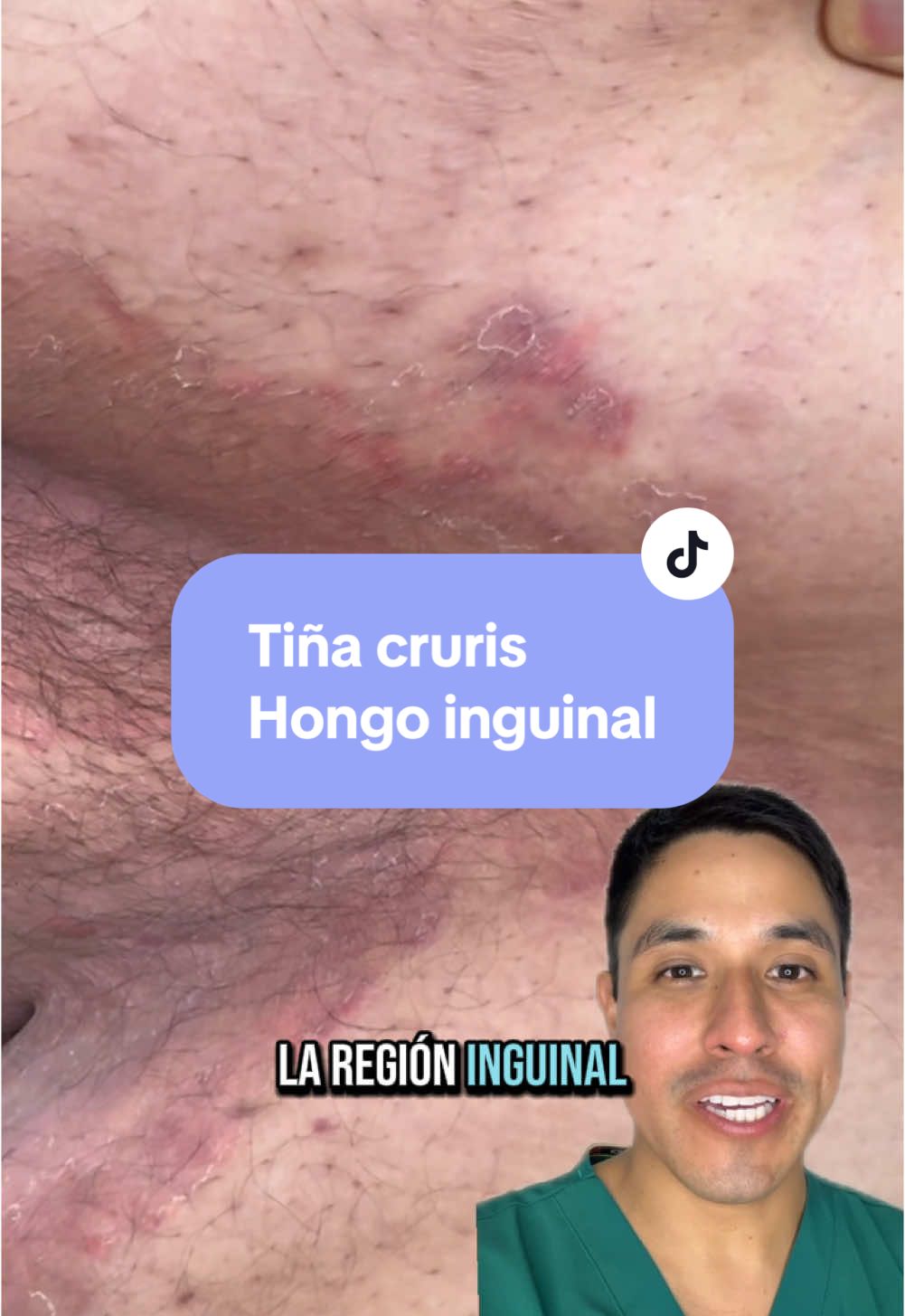 #dermatologo #dermatologia #hongos #piel #enfermedad #medicina #medico #doctor #derma #fyp #salud